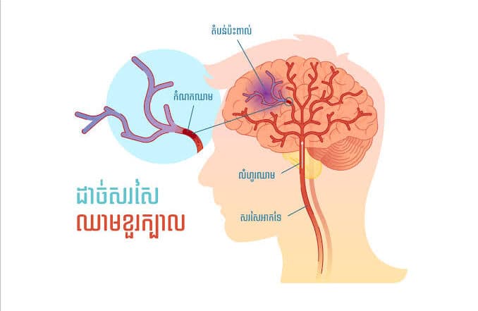 កត្តាហានិភ័យពីជំងឺដុំសាច់ខួរក្បាល