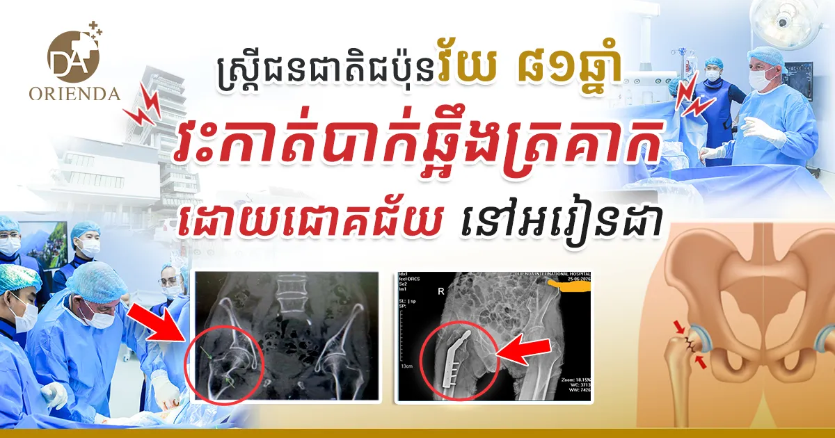 ស្រ្តីជនជាតិជប៉ុនវ័យ ៨១ ឆ្នាំ វះកាត់បាក់ឆ្អឹងត្រគាកដោយជោគជ័យនៅ អរៀនដា